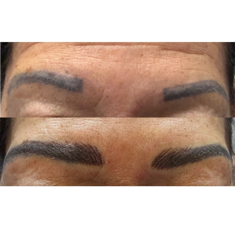 Ultrasonic Cavitation Body Shaping