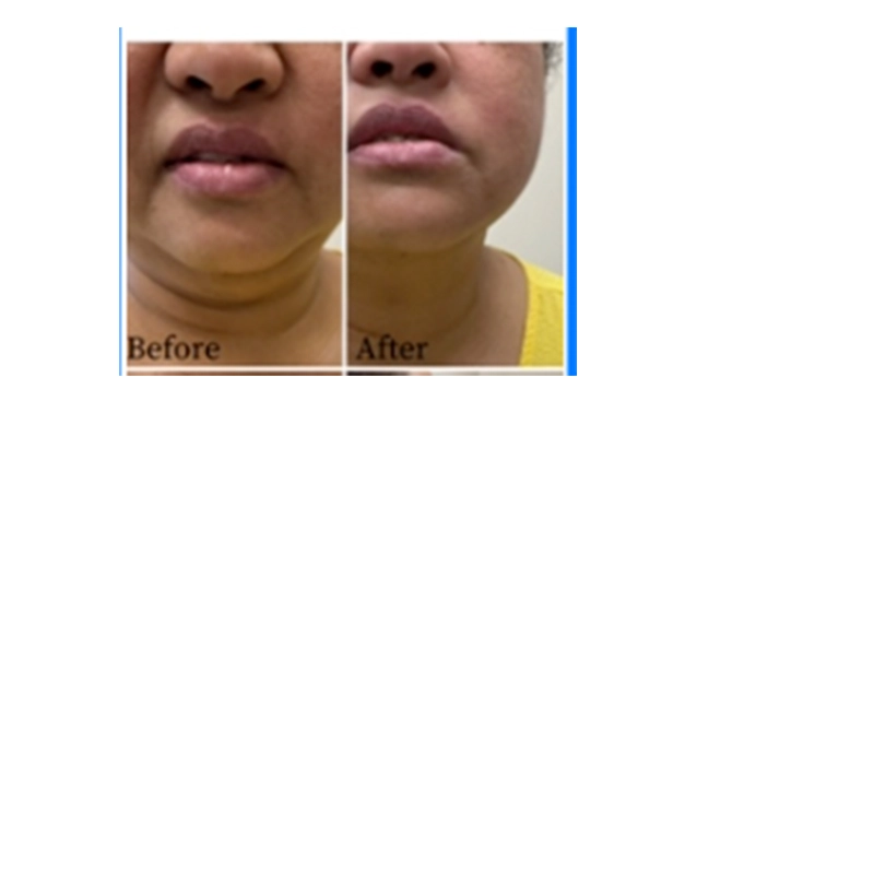 Ultrasonic Cavitation Body Shaping