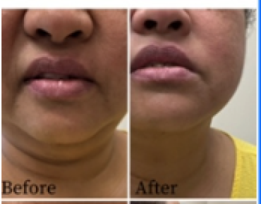 Benefits of RF Skin Tightening and Body Contouring