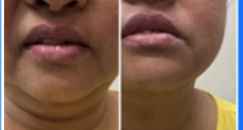 Benefits of RF Skin Tightening and Body Contouring